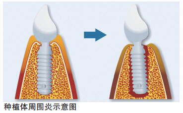 種植體(tǐ)周圍炎